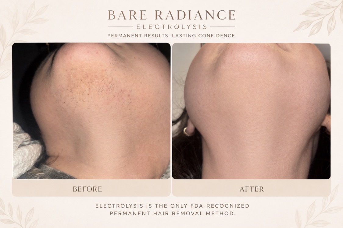 Before and after electrolysis treatment progress showing reduced unwanted chin and neck hair after a series of appointments.