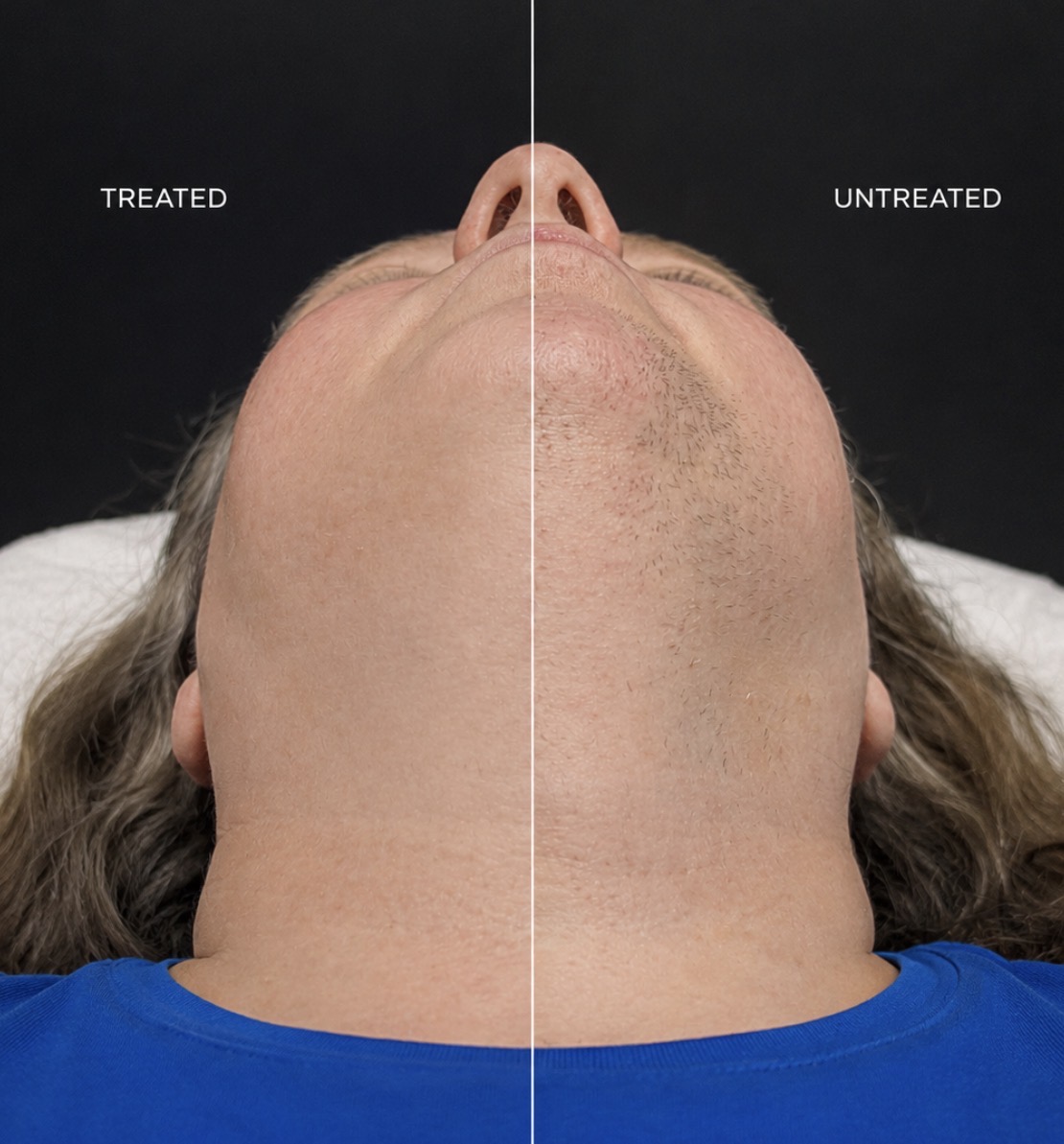 Real client progress photo showing treated versus untreated side with reduction in unwanted chin and neck hair from consistent electrolysis treatment at Bare Radiance Studio