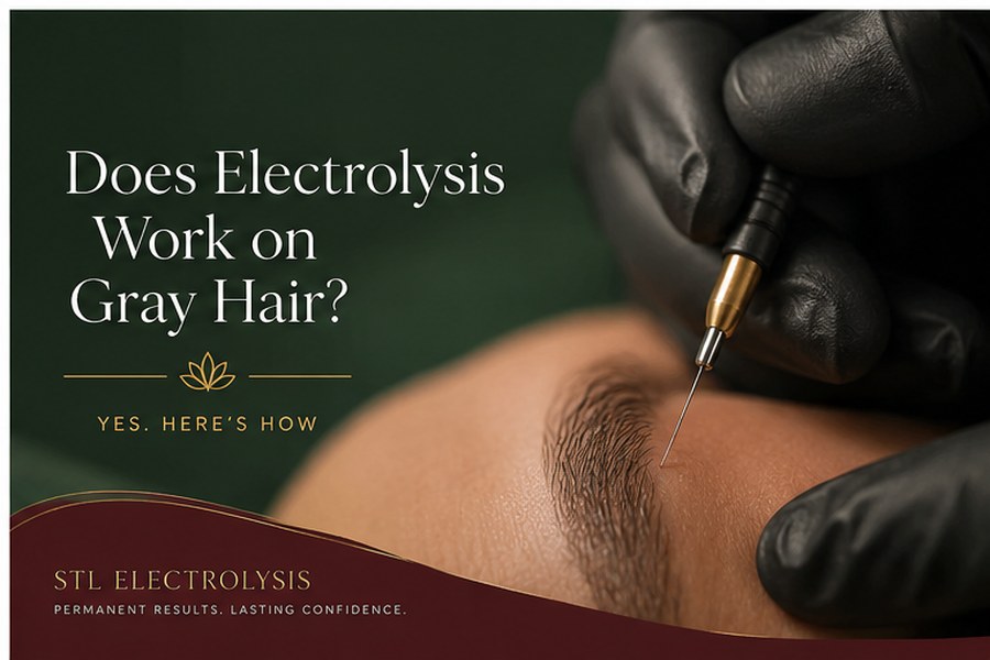 Electrolysis treatment being performed on gray and white hair that laser cannot target